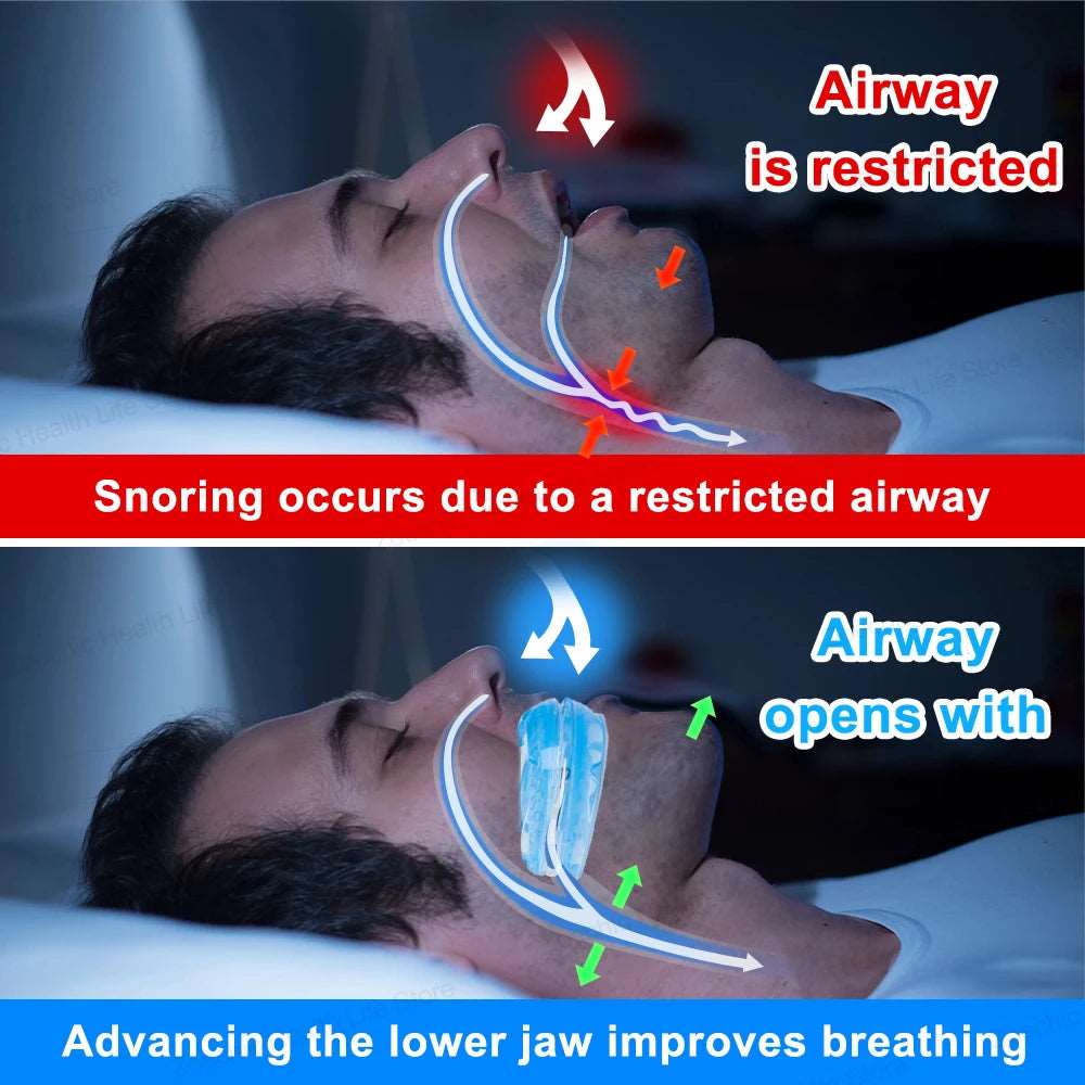 Guide to Better Sleep: Why an Adjustable Anti-Snoring Mouth Guard Matters