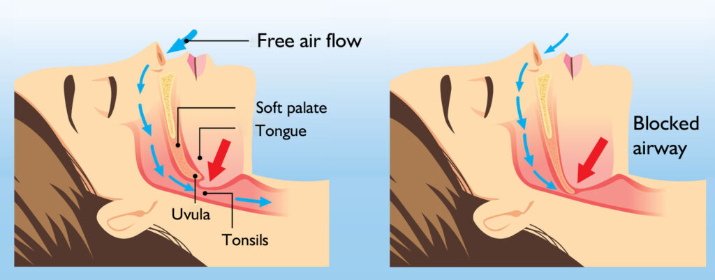 Snoring Surgery Options